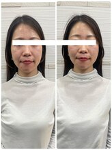 長寿鍼灸院 長寿整骨院/美容鍼50本の効果★小顔効果