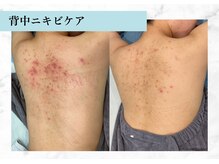 リメイク 銀座(REMAKE)/幹細胞ゴールドピーリングボディ