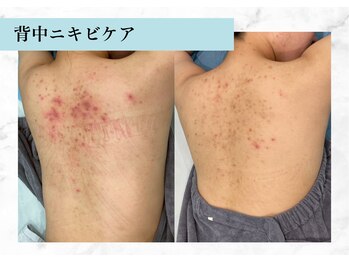 リメイク 銀座(REMAKE)/幹細胞ゴールドピーリングボディ