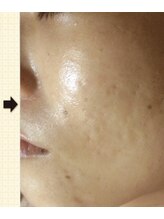 ノットノット 自由が丘(Not Knot)/２.グリーンピール 5days　3回後