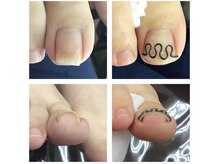 厚木 海老名 巻き爪矯正センター/事例【ツメフラ法巻き爪矯正】