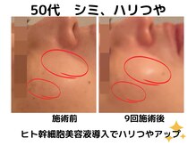 エンジェルエッグ/◆美容液導入でハリ艶シミケア