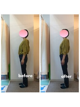 みらい整骨院/以前から気にしてた反り腰改善