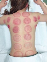 たくみ整体院/【吸い玉】施術における残色色体