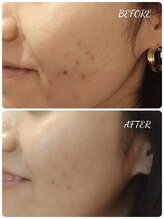 エタニティ 西宮店(Eternity)/韓国ハーブピーリング