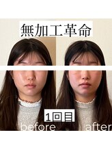 ノア(NOA)/ビフォーアフター