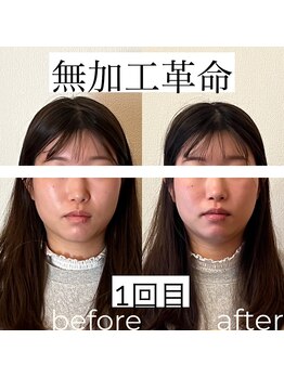 ノア(NOA)/ビフォーアフター