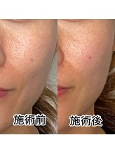 プレシャスワン 越谷店/美容鍼ほうれい線ピンポイント！