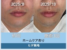 アロマ(AROMA)/ニキビ×ヒゲ脱毛が同時に叶う