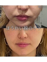 ビュウナ 銀座(BEAUNA)/マルチウェーブリフト