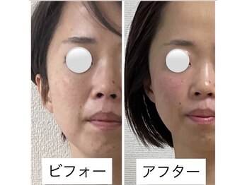 ヴィクトリアサロン(VICTORIA SALON)/ほうれい線や小顔施術も大人気★