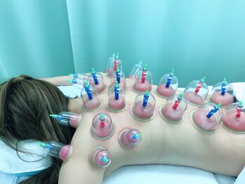 たくみ整体院/吸い玉