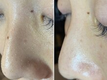 レイ(Rei)/大人気！毛穴エクストラクション