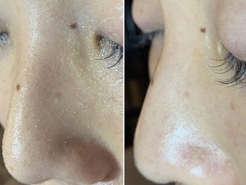 レイ(Rei)/大人気！毛穴エクストラクション