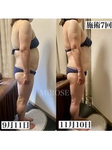 ミローズ(MIROSE)/２週間に１回＋朝酵素でこの結果