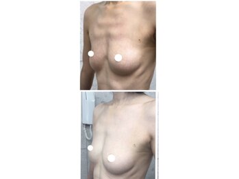 サロンツキ(salon tuki)/【バストアップ】症例★