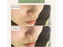 ベル 下北沢(Belle)/ハイドラフェイシャル