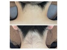 ミース 鹿児島店の雰囲気(【うなじビフォーアフター】ブライダルにもお勧めなうなじ脱毛☆)