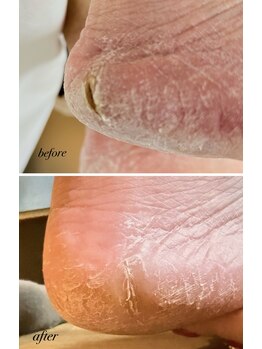 ラヴィ(La vie)/かかとパックリと…