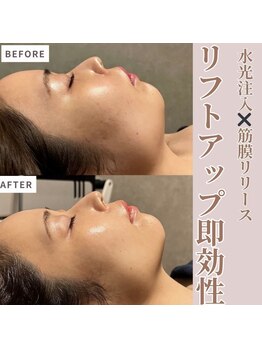 マヴィ 守口店(MavY.)/リフトアップが叶う！