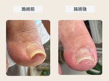 ルポ 伊勢/巻き爪ケア