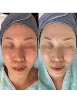 イーヴ(Eave)/【肌質改善】ハイドラ毛穴洗浄