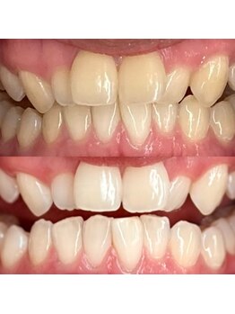 シエル(CIEL)/医療提携セルフホワイトニング