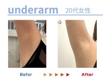 キングスサロン 熊本の雰囲気（脇のポツポツも無くなったら快適♪脇は効果早いとお声頂きます♪）