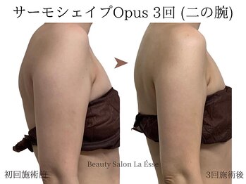 ラエッセ(La Esse)/ほっそり二の腕もつくれる〇