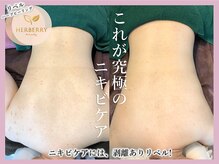 ハーバリー ハーブピーリング 大阪梅田店(HERBERRYハーブピーリング)/梅田ハーブピーリングHERBERRY