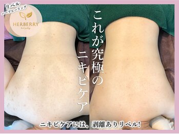 ハーバリー ハーブピーリング 大阪梅田店(HERBERRYハーブピーリング)/梅田ハーブピーリングHERBERRY