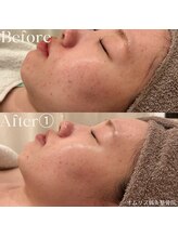 オムリス鍼灸接骨院/before after/ハーブピーリング