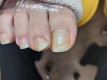 ＵＰジェル／塗り替えbefore