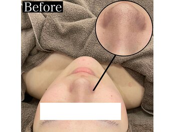 ビーブルーセブン(B.BLUE7)/【最新毛穴洗浄★Before】