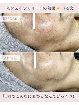 ネリネ(Nerine)/光フェイシャル1回の効果