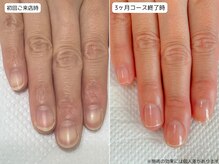 カピリナ(Ka Pilina)/自爪育成・深爪・川崎