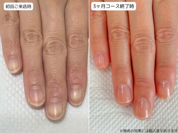 カピリナ(Ka Pilina)/自爪育成・深爪・川崎