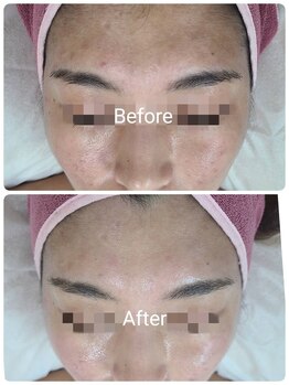 サロンド シェリー(Salon de Cherie)/ハーブピーリング 3回目