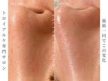 ファシネアオヤマ(FACINE AOYAMA)/施術一回でこの変化♪