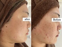 アワピール 成田公津の杜店(AWA PEELL)/ハーブピーリングでニキビ改善