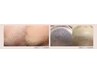 メンズ髭 脱毛【リピート率満足度90%】初回限定40%OFF◎￥11.000→6.600円