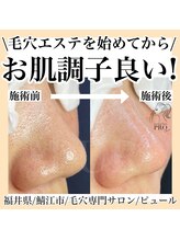 ピュール 鯖江店(PUR)/毛穴サロン/毛穴ケア/毛穴洗浄