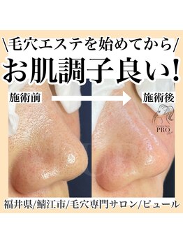 ピュール 鯖江店(PUR)/毛穴サロン/毛穴ケア/毛穴洗浄