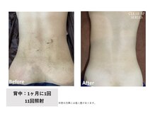 エクラ(eclat)/脱毛