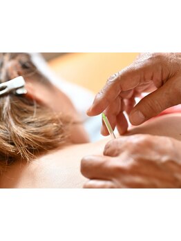 鍼灸施術を受けたい