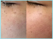 ヴィオール 名古屋栄店(VIOR)/最強美白ピーリング◎ シミ改善