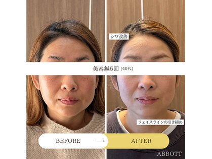 アボット(ABBOTT)の写真