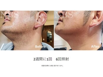 ラディアアンドココサロン(Radia&Coco_salon)/ヒゲ脱毛ビフォーアフター☆