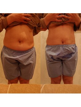 アリュール(ALLURE)/痩身ビフォーアフター3