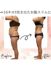 サロン ド ボーテ ラーンジュ 岐阜店(salon de beaut'e L'ange)/ハイパ-ナイフEX2ダイエット痩身